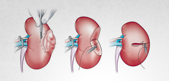 Chronic Kidney Disease